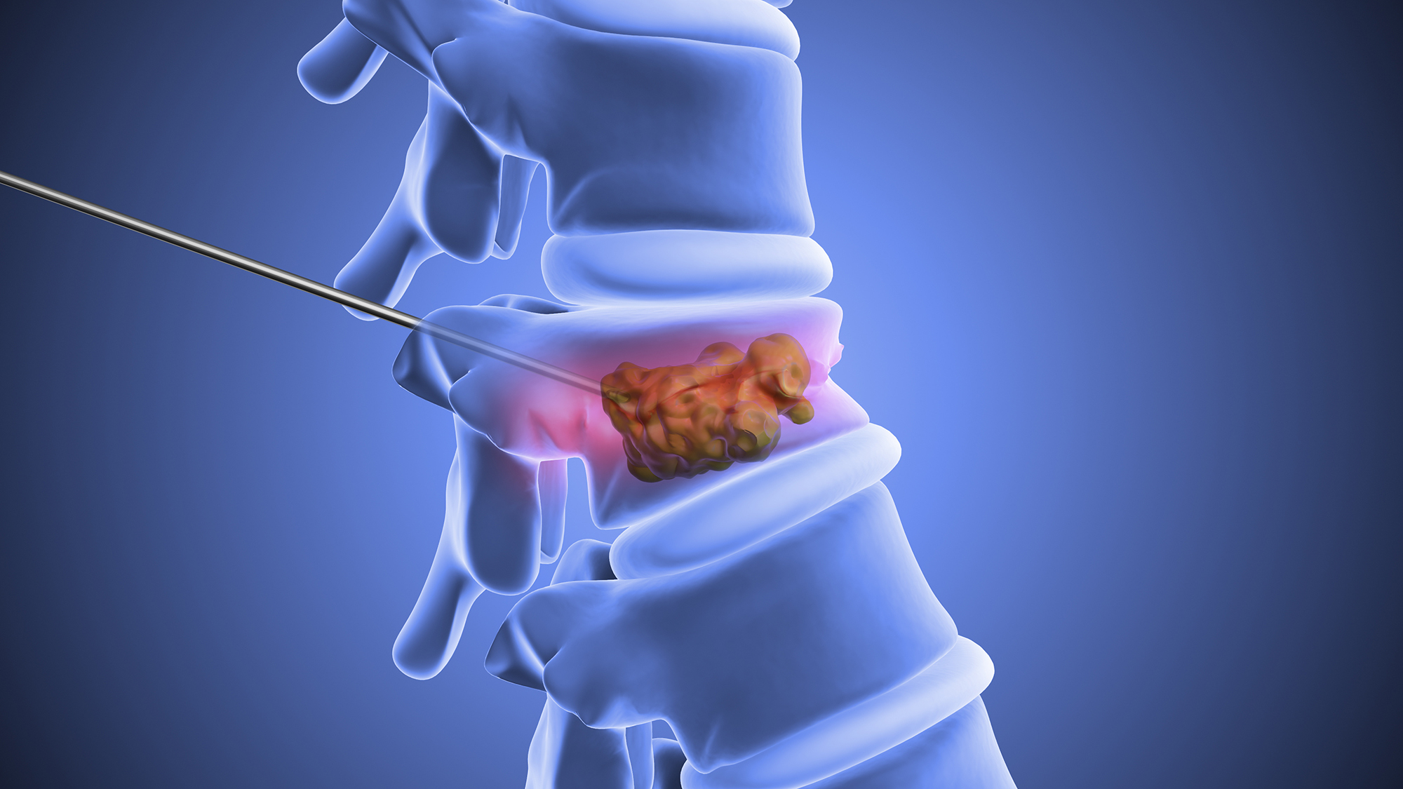 kyphoplasty graphic